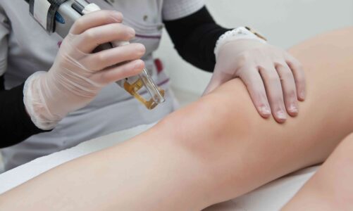 FAQs About Laser Hair Removal Answered